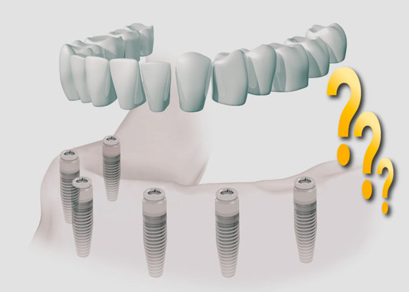 Preguntas frecuentes de implantes dentales