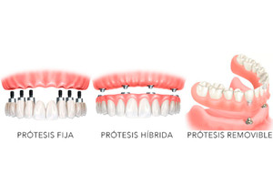 Tipos de Protesis