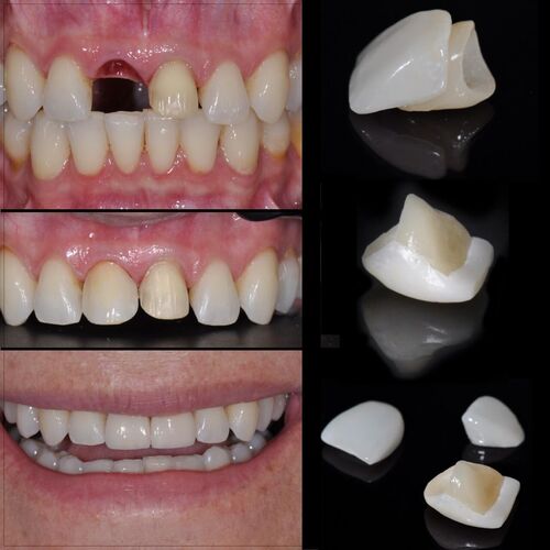 Imagen de Implantes Tradicionales