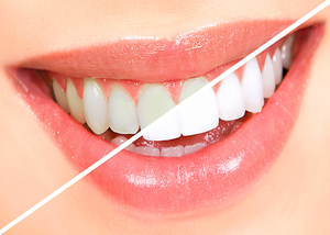 Imagen de Blanqueamiento Dental 