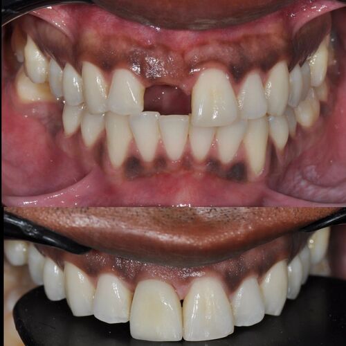Imagen de Carga Inmediata en Implantes