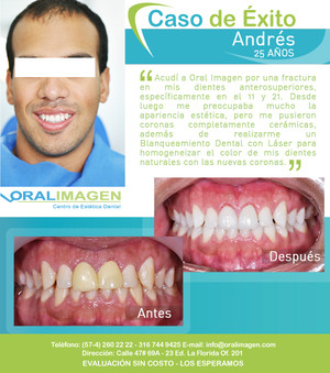 Imagen de Caso de Éxito - Coronas totalmente cerámicas