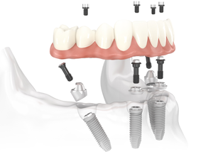 Imagen de Prótesis Fija en Implantes