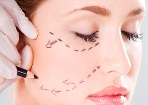 Imagen de Bichectomía