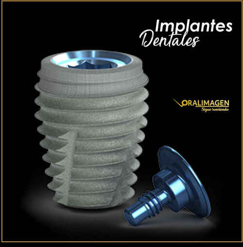 Imagen de Implantes dentales según tus condiciones óseas y clínicas
