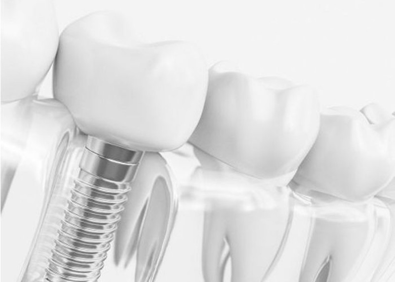Implantes dentales segn tus condiciones seas y clnicas